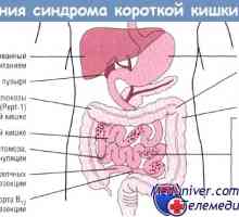 Критичната дължина на червата със синдром на късите черва (НКМ)