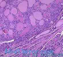 Щитовидната жлеза аденом патоанатомия, форма,