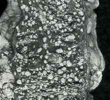 Аденоматозна (семейство) полипоза на дебелото черво
