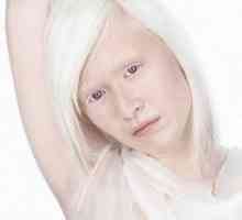 Албинизъм при хора, око