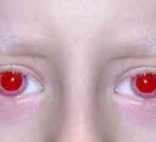 Албинизъм при хора: симптоми, причини, симптоми, лечение