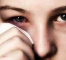 Алергичен конюнктивит: лечение, симптоми, причини, симптоми