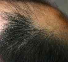 Алопеция косата: за лекуване, причини, симптоми, признаци