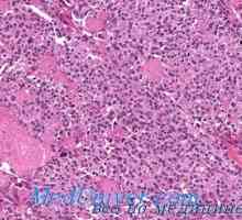 Рак на щитовидната жлеза амилоид. Сцирозен.бронхиоларен рак на щитовидната жлеза