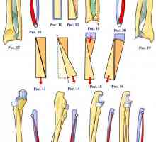 Анатомичният структурата на радиус и лакътната кост единица