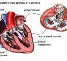 Аортната болест на сърцето: лечение, симптоми, признаци, причини