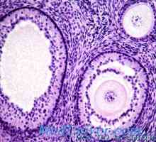 Arrhenoma яйчниците хистология, патоанатомия