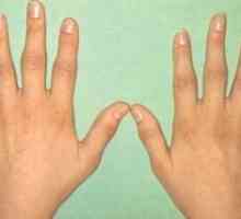 Артрит метакарпална фаланга съвместно от ръката: лечение, симптоми, признаци, причини