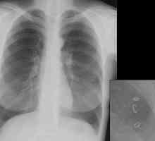 Ascaris в белите дробове, гърлото, носа, дихателните пътища при хората