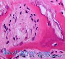 Атеросклерозата на фона на инсулинова резистентност. Метаболизма на мазнините при диабет и…