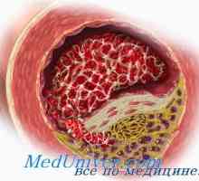 Атеросклерозата в менопаузата и менопаузата. Ефектът на тестостерона върху атеросклероза андрогени
