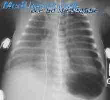 Баротравма белите дробове по време на декомпресия. Патогенезата на белодробна баротравма