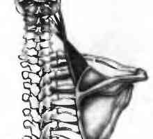 Болки в гърба, причинени от мускулна повдигащ скапула
