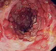 Болест на Crohn, рак на дебелото черво, симптоми и лечението