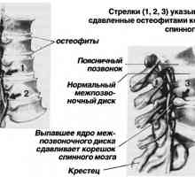 Болки в гърба. спондилоартроза