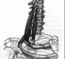 Болки в гърба, причинени от мускулите на разностранни