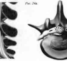 Болки в гърба херния ядро ​​пулпо-зус (дископатии)