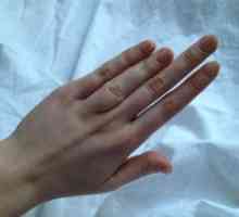 Брахидактилия палец: причините, лечение, симптоми, признаци