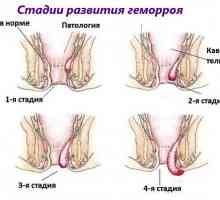 Четири етап (степен) на хемороиди