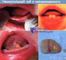 Неонатални зъби новородени причини, диагноза