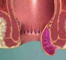 Какво предизвиква образуването на хемороиди?