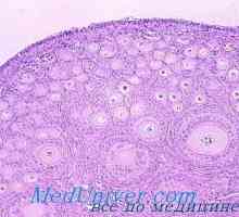 Meristoma яйчниците. Tekakletochnaya тумор Tecoma