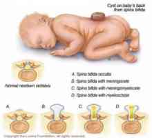 Дефектите на невралната тръба при деца: енцефалоцеле, meningomyelocoele