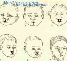 Дефекти в развитието на лицата на ембриона. Дефекти в плода челюстите