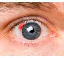 Диабетна ретинопатия: симптоми, лечение, етап, усложнения
