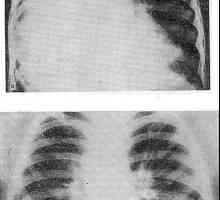 Диагностика на тумори на гръдния кош. вътрегръдната гуша
