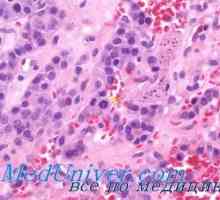 Диагностика на рак на щитовидната жлеза