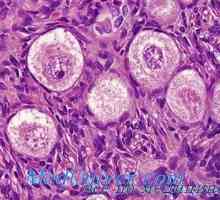 Disgerminoma семином или яйчниците. тумори на яйчниците Lipoidnokletochnye вирилизиращи