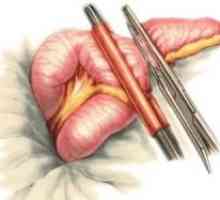 Дивертикулоза червата (дебелото черво): лечение, симптоми, диагностика