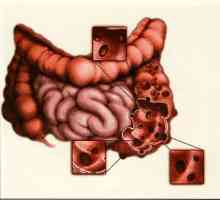 Дивертикулоза на дебелото черво