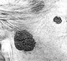 Доброкачествените тумори на кожата, главата и шията: пигментни невуси