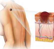 Доброкачествените тумори на кожата: видове, класификация, лечение, симптоми