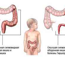 Dolichosigma на червата при деца