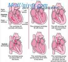Сърдечният дебит след инфаркт. Компенсирана сърдечна недостатъчност