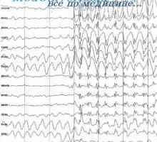 Какви са причините и спира голям епилептичен припадък? Малая епилепсия