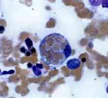Хемофагоцитна лимфохистиоцитоза: лечение, причини, прогноза