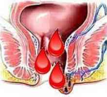 Хемороиди по време на менструация, защо се изострят пред тях?
