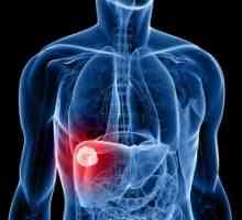 Хепатоцелуларен карцином на черния дроб: симптоми, лечение, прогноза, диагноза