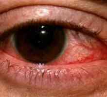 Херпесен кератит очите: лекуване, профилактика и симптоми, причини