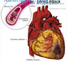 Инфаркт на миокарда. Причини за смърт в миокарден инфаркт