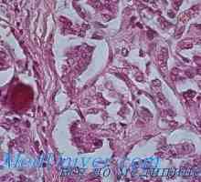 Hyperparathyroid генерализирана влакнест остеодистрофия (болест на фон Реклингхаузен) морфология,…