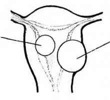 Хистероскопия в диагностиката и лечението на миома на матката
