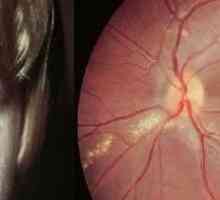 Очни Токсокариазис, симптоми и лечение при възрастни