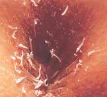 Worms в репродуктивните органи във влагалището, матката, устните