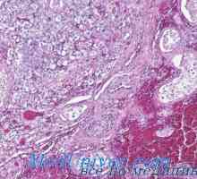 Тестикуларни тумори Gormonalnoaktivnye leydigomy