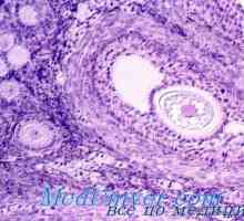 Gormonalnoaktivnye тумори на яйчниците. Follikuloma